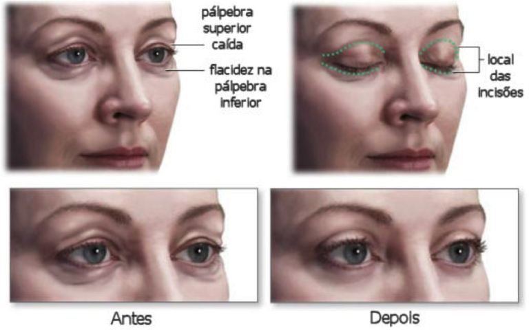 Saiba Mais Sobre Blefaroplastia Medvisao Cirurgia Pl Stica Ocular