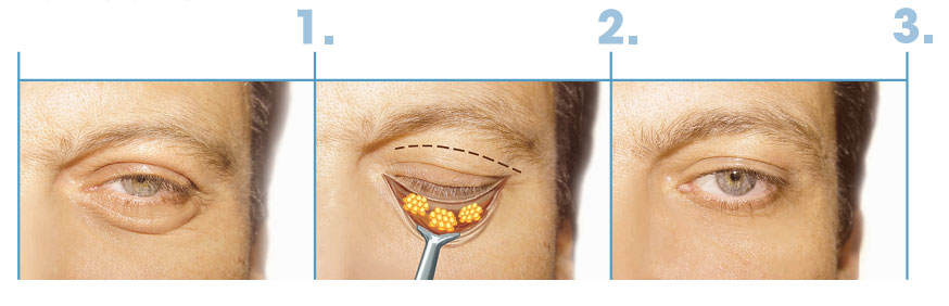 Saiba Mais Sobre Blefaroplastia Medvisao Cirurgia Pl Stica Ocular