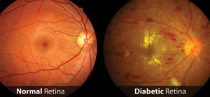 Como a Diabetes pode afetar a visão?