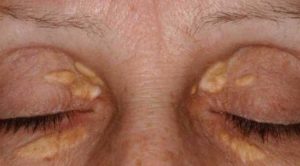 O Xantelasma é um pequeno depósito de gordura e colesterol que ocorre logo abaixo da superfície da pele, especialmente ao redor dos olhos.