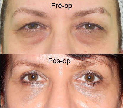 Como é a Recuperação após blefaroplastia? - MedVisao - Cirurgia